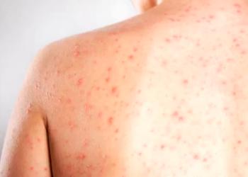 Brasil registra casos de sarampo em 88 cidades de 11 estados