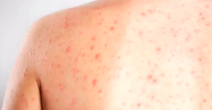 Brasil registra casos de sarampo em 88 cidades de 11 estados