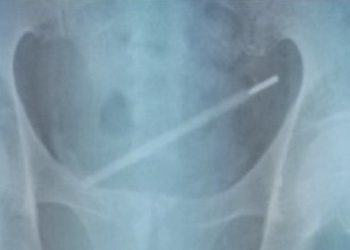 Homem fica com termômetro dentro da bexiga por 11 dias